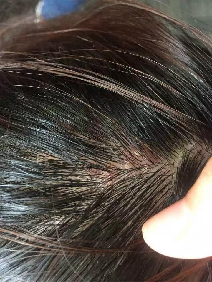 头皮屑重怎么去除头皮屑,头皮屑过多什么原因怎样去除