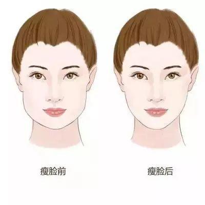 打完瘦脸针多久脸才开始瘦,打瘦脸针后多久能咬东西