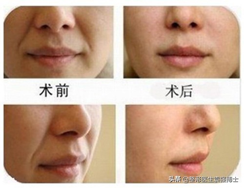 整形法令纹怎么去除最快最有效,整形医院祛法令纹用什么方法好