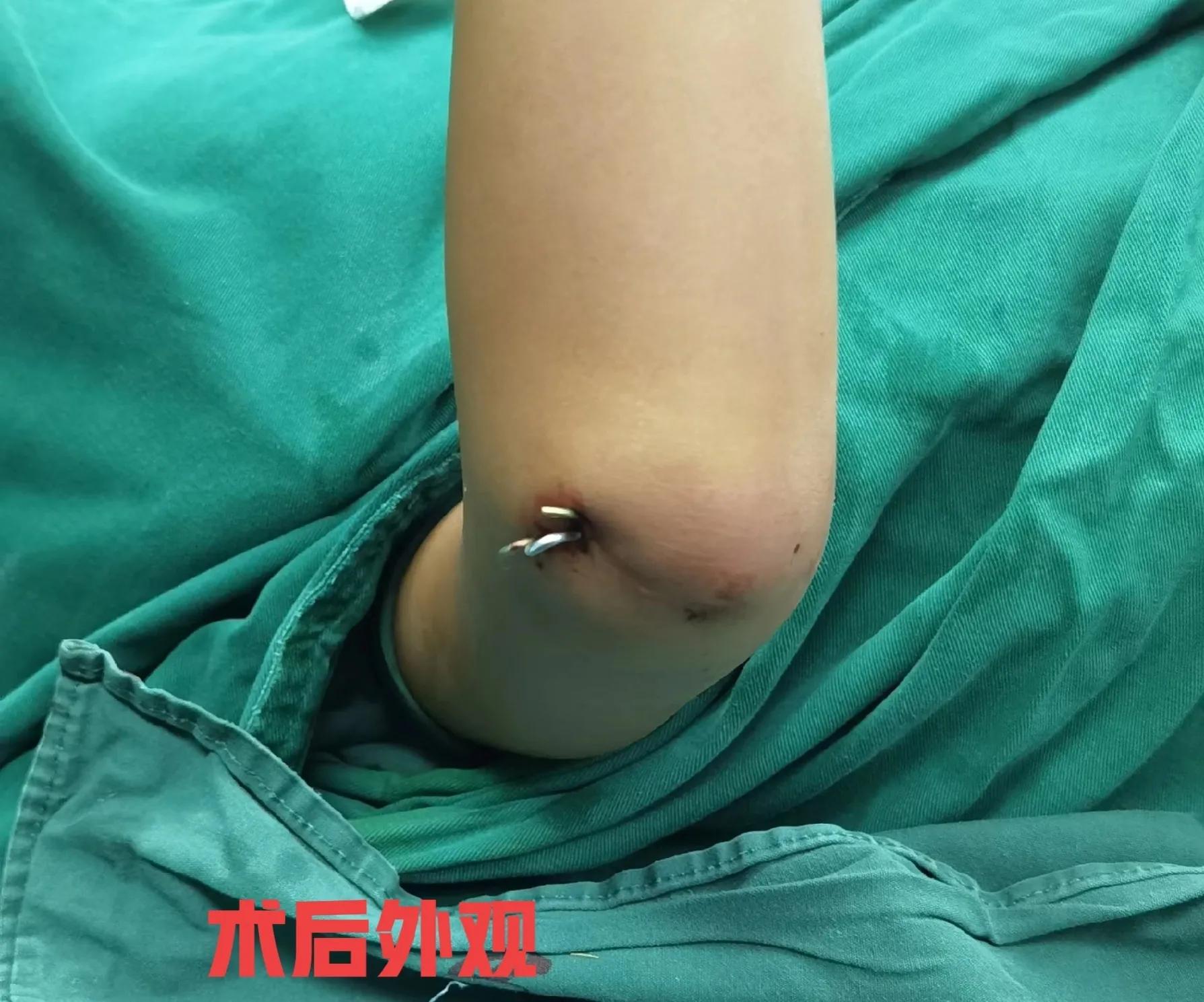 肱骨髁上骨折手法复位图,肱骨髁上骨折克氏针固定