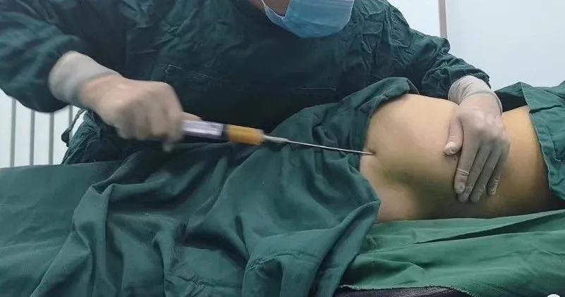 自体脂肪填充全脸逆袭,自体脂肪填充的真相来了