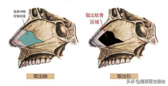 鼻中隔软骨隆鼻失败怎么修复,鼻中隔软骨隆鼻应注意什么