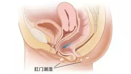 不做有「痔」青年——痔疮需要这样防治