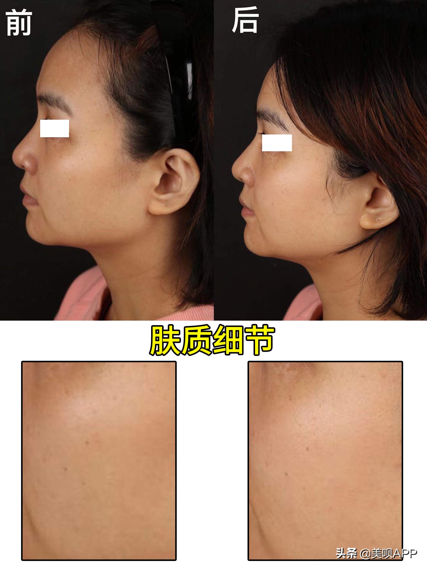 西京医院整形美容科面部年轻化,面部美容年轻化手术科普