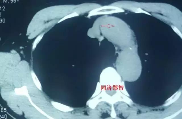 磁共振可以替代cta检查主动脉夹层,超声心动图联合cta诊断主动脉夹层