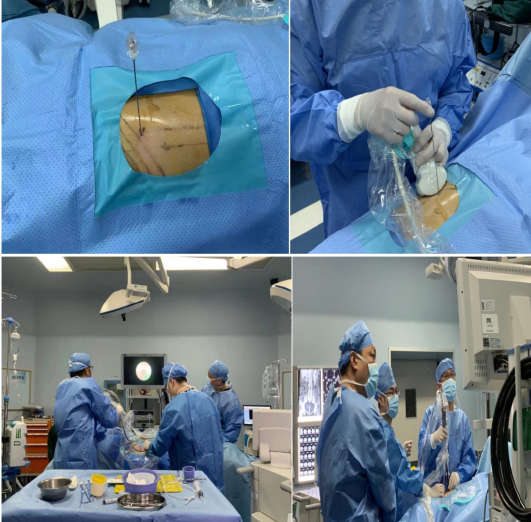 腰痛要警惕四种肾结石原因,腰痛结石痛得剧烈怎么办