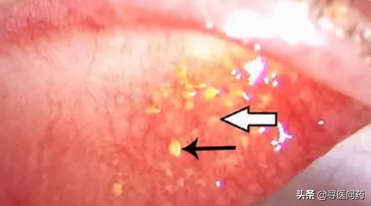 女子眼睛长石头,美女眼睛里长出结石