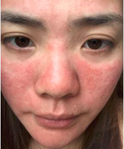 这几天起了皮肤起红疹该怎么办好呢？脸上红痒可能是什么引起的？