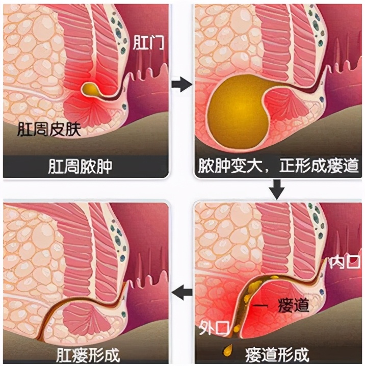 怎么做促进肛周脓肿恢复,如何能帮助肛周脓肿快速吸收