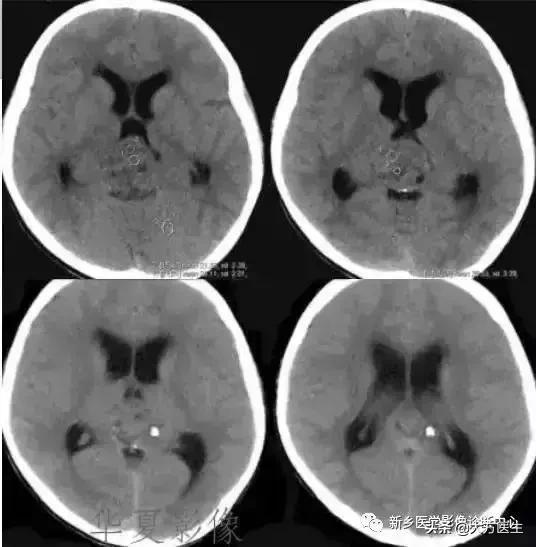 钙化灶是良性肿瘤的可能性大吗,颅内肿瘤钙化发生率最高
