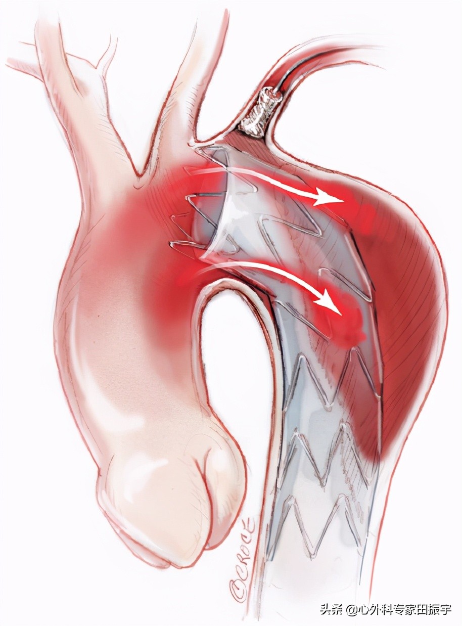 主动脉夹层破裂的院前急救,主动脉夹层破裂的临床表现和处理