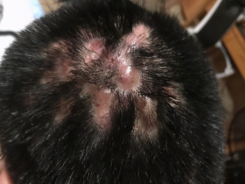 简述穿掘性毛囊炎的治疗方法