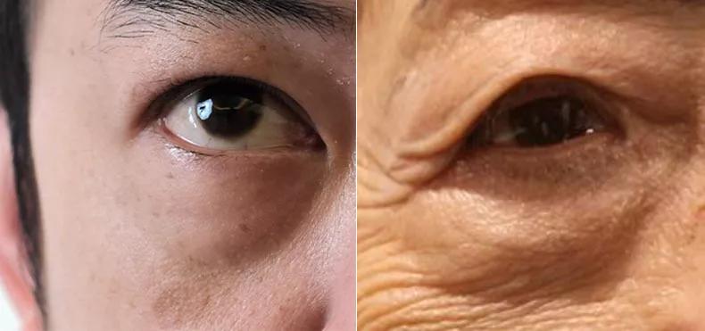 治眼袋三个小妙招快速去眼袋,上眼袋大最简单的去眼袋的方法