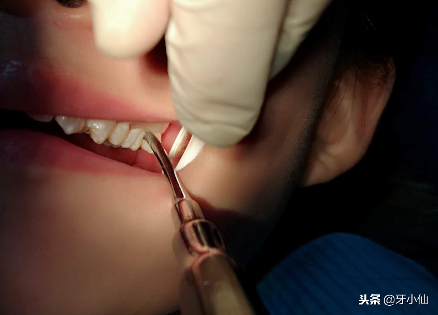 拔牙疼不疼拔牙后需注意什么,拔牙最佳时间和拔牙注意事项