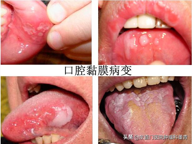 化疗口腔黏膜炎的分期,放化疗相关口腔黏膜炎预防及护理