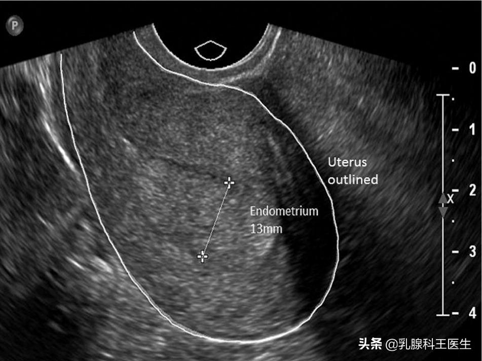 诊治子宫内膜增厚,吃内分泌的药子宫内膜增厚怎么办