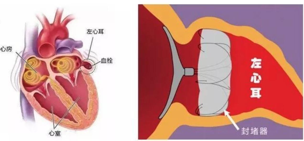 心脏噗通乱跳？医生告诉你，可能是危害极大的房颤！要警惕