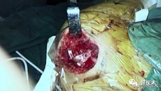 治疗肩锁关节脱位，有最好的方法吗？