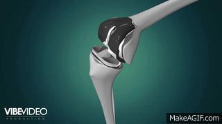 膝盖骨刺初期有什么症状,膝盖骨刺最严重后果怎样