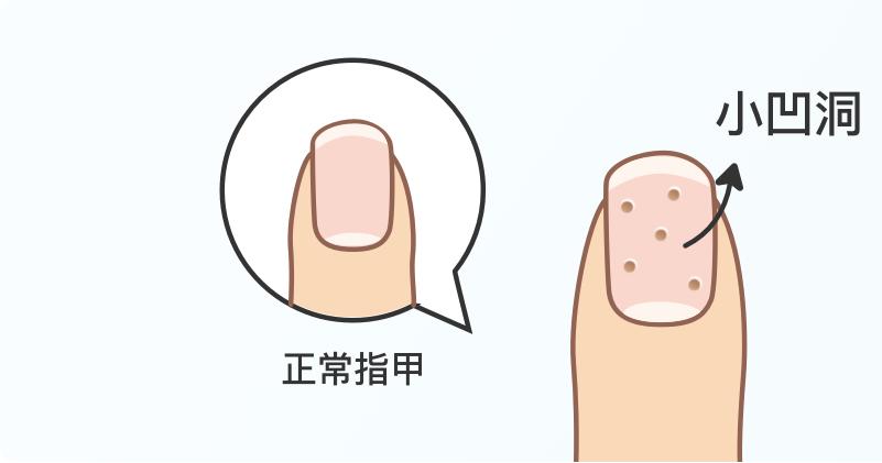 得了灰指甲一个传染俩真的假的,得灰指甲的人碰过的东西会传染吗