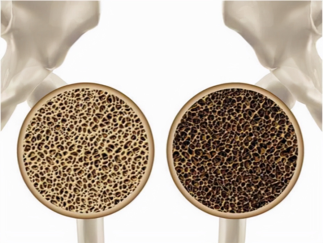 远离骨质疏松食谱,骨质疏松禁忌食物一览表