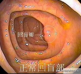 结肠镜检查，痛苦并快乐着