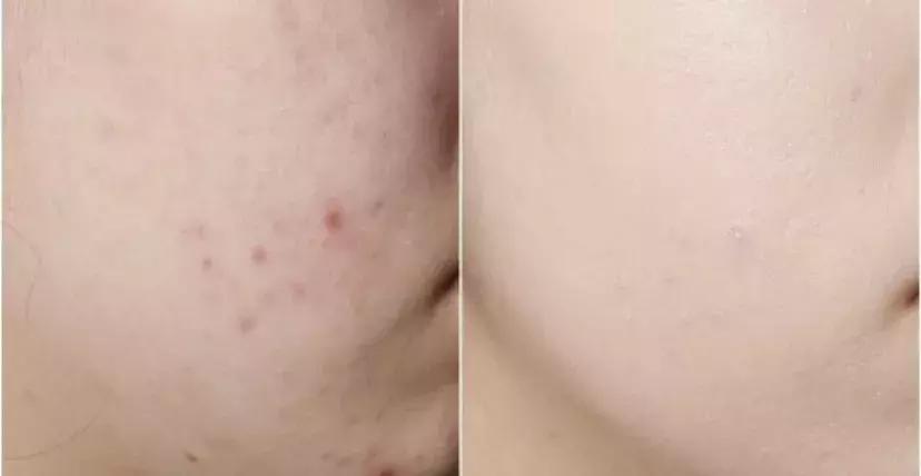 日本的美白针,日本最强美白针