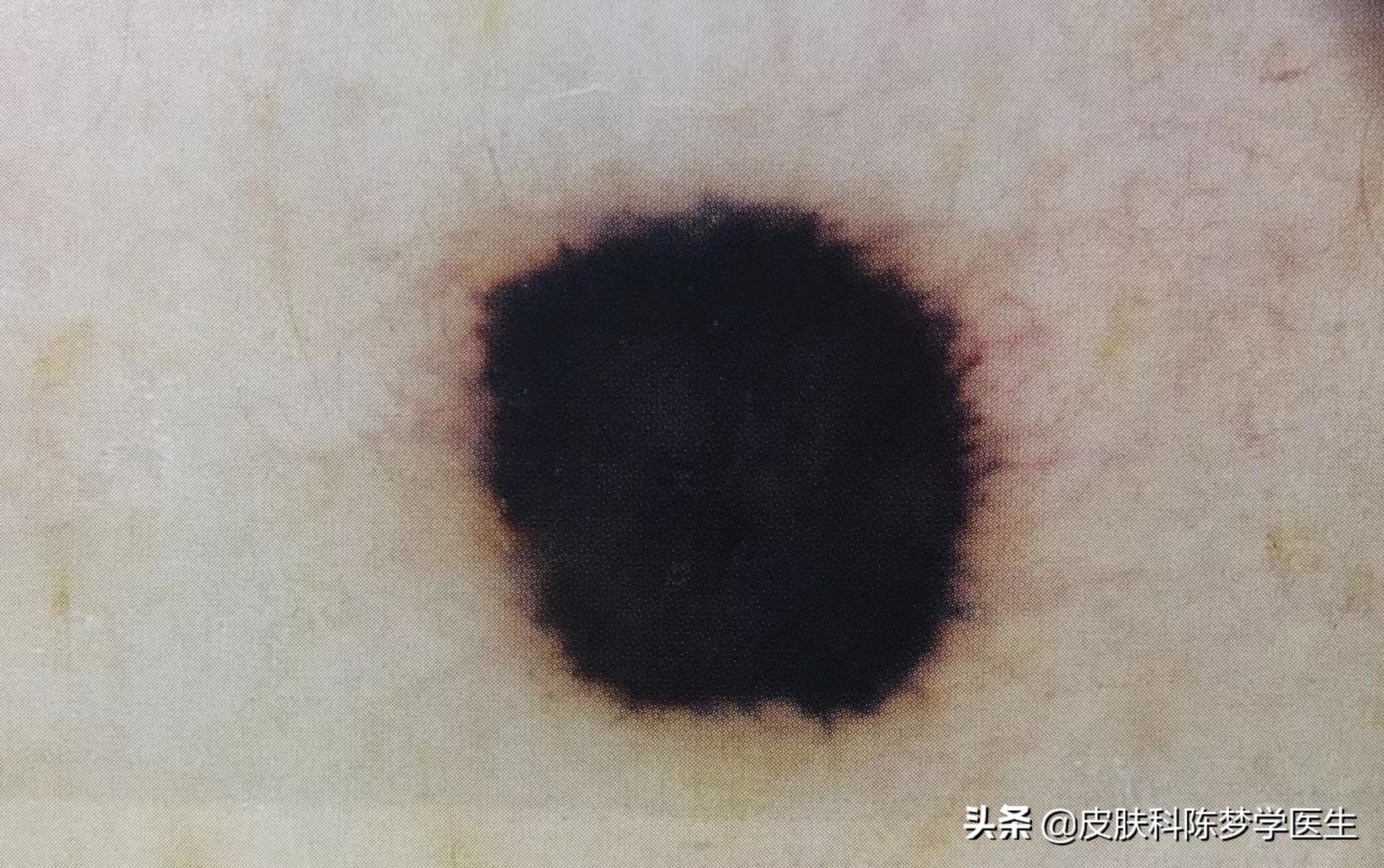 激光点痣后怎么判断有没有癌变,激光点痣会诱发痣癌变是真的吗