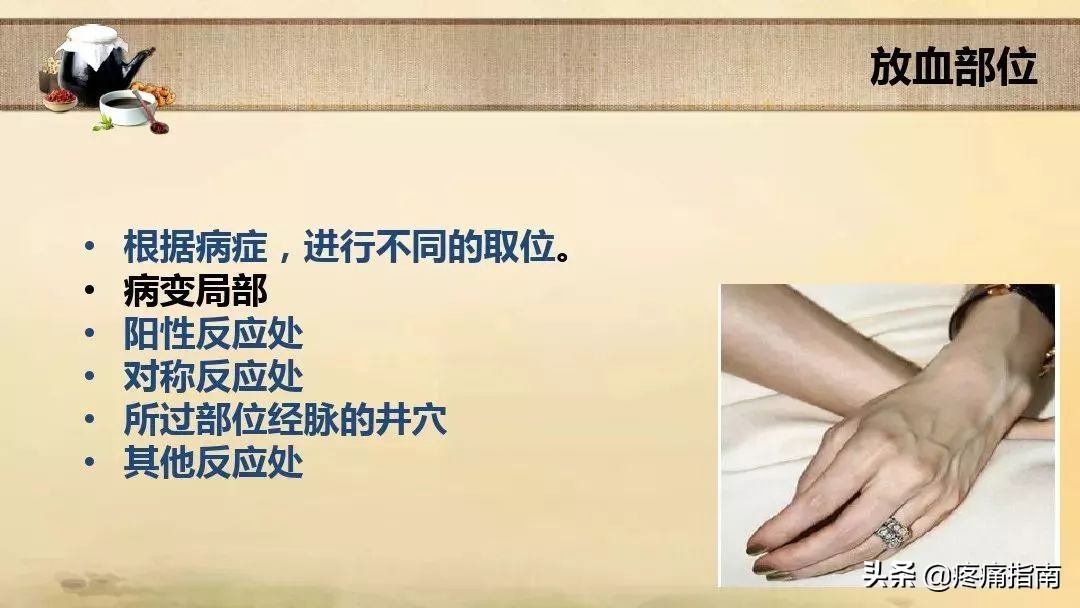 中医刺络放血疗法,中医刺络放血