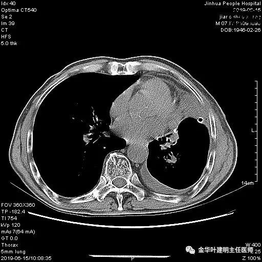 手术引起乳糜胸,有没有做了肺结节手术后是误诊的