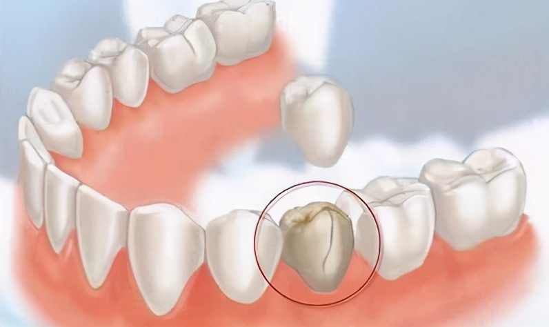 儿童蛀牙牙痛补牙还是根管治疗好,牙痛蛀牙要补牙还是根管治疗