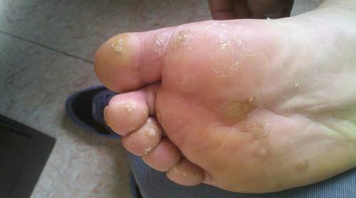 治疗跖疣火针和冷冻哪个疗效好,多发性跖疣的火针治疗