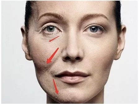 不通过医美法令纹泪沟怎么改善,法令纹泪沟最有效的解决办法