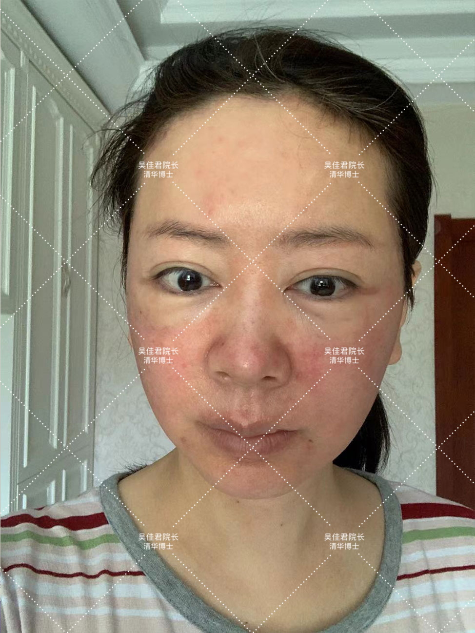 54岁姐姐分享大拉皮术后恢复历程,48岁做拉皮手术的真实经历