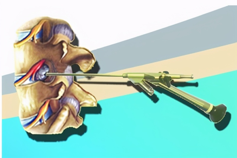 腰椎管狭窄微创手术后戴腰带多久,腰椎管狭窄微创手术后注意事项