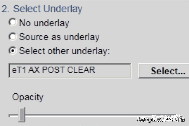 飞利浦磁共振脑灌注怎么测量,飞利浦核磁诊断教学