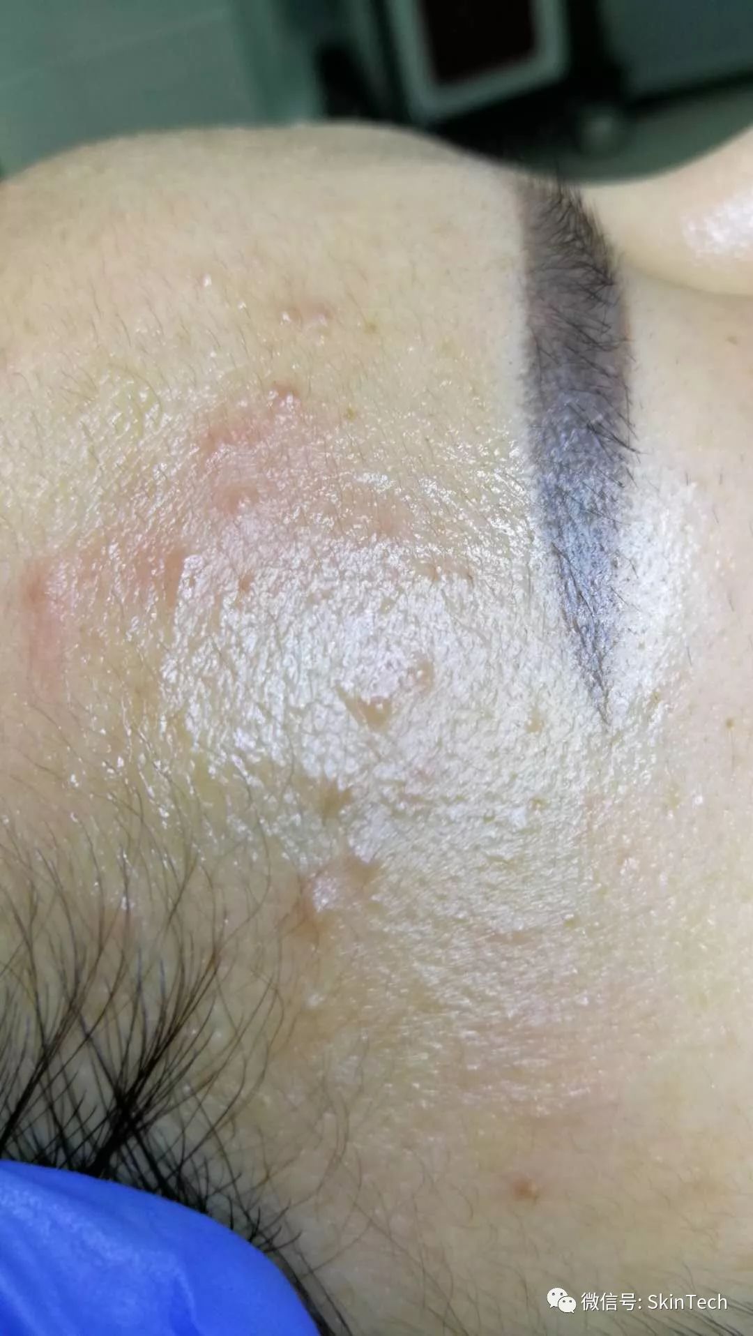 辟谣逆光疹,逆光疹是伪概念吗