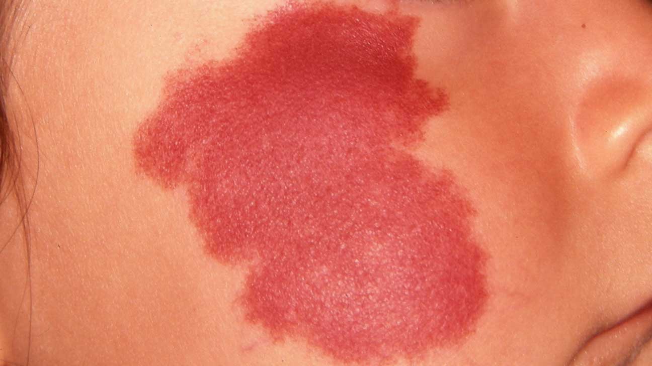 肚皮上长凸起的红色的痣要不要紧,前胸后背都长红色的痣是什么原因