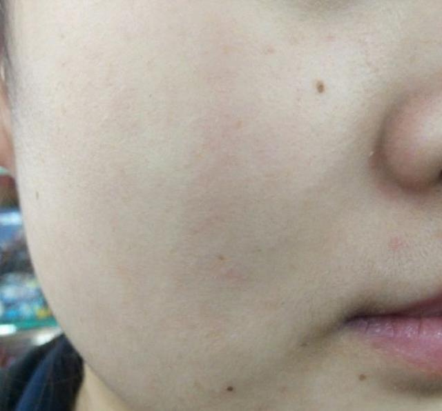 角质层薄的皮肤怎么护理最好,脸颊角质层薄脸会红那要怎么办