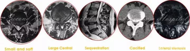 经皮腰椎间盘切除术有何优缺点,什么是经皮内镜腰椎手术