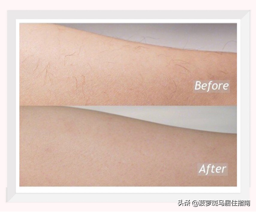 永久性脱毛的最好方法,真正能永久脱毛的办法