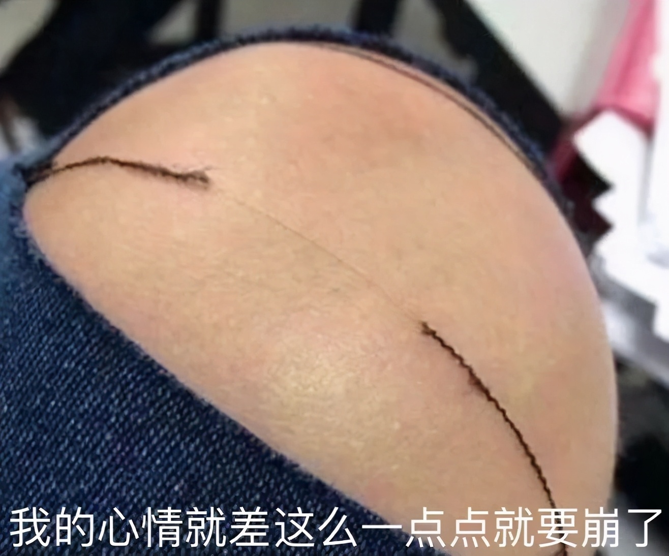 为什么长痘痘一直反反复复,反复长痘痘这5个坑别再踩了