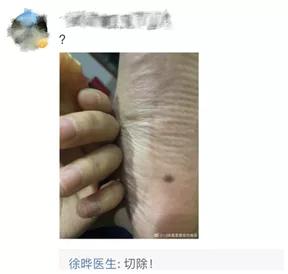 周边不规则的痣需要割掉吗,医生说什么样的痣容易癌变