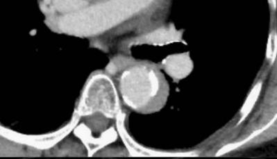 胸部Ct平扫能查出主动脉夹层吗,主动脉夹层cta影像图片解读