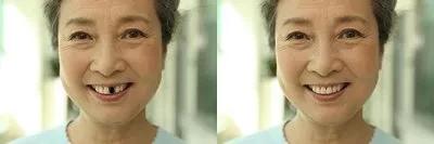 缺一颗上牙在边上镶活牙行吗,单颗牙缺失一个月不补可以吗