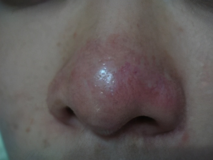 在鼻子上挤出的白色物质是什么,鼻子上的小疙瘩挤出来的白色东西