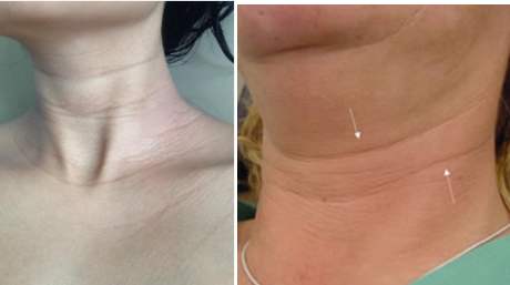 7招改善颈纹28天养出光洁天鹅颈,脖子上有颈纹怎么去除小妙招