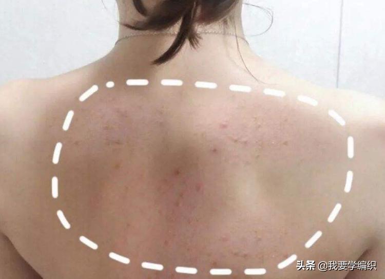 后背长痘的原因和改善方法,后背长痘太可怕了该怎样调理