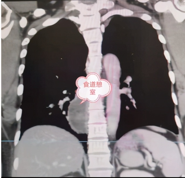 盘江总医院成功开展首例食管憩室切除+食管重建术