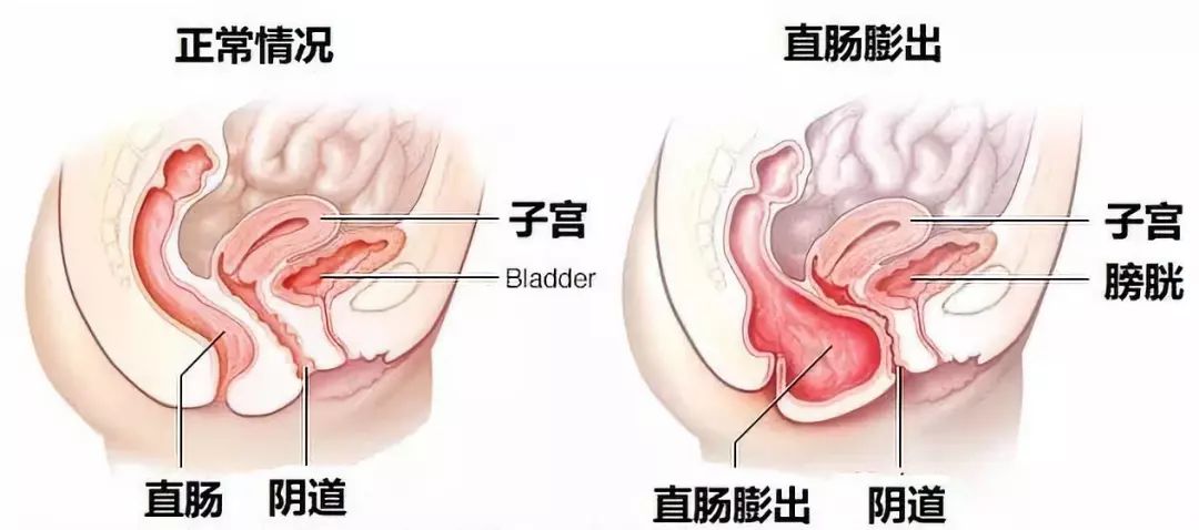 盆底肌松弛漏尿膨出最佳治疗方法,产后10年漏尿盆底肌康复